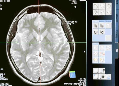 CT scan of a cross section of the brain